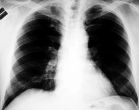 Du dichloroac�tate contre le cancer
