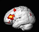 Un laser contre le cancer du cerveau